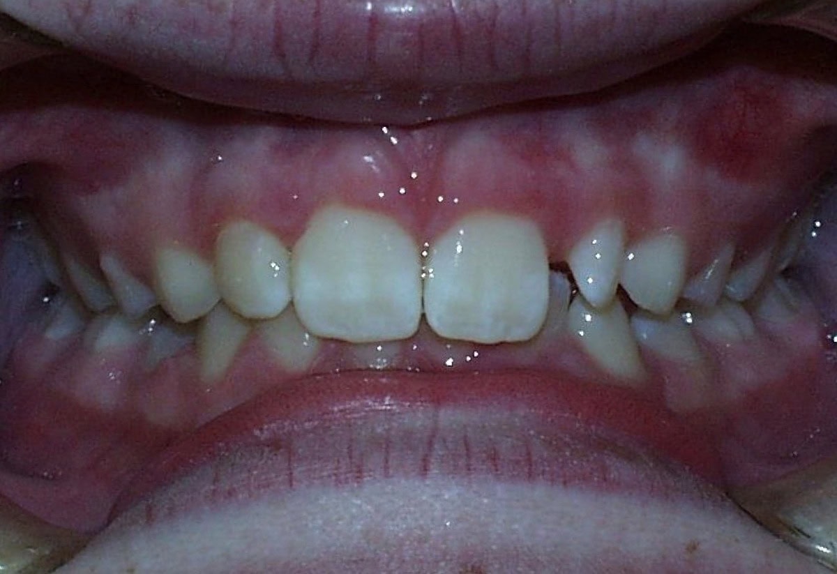 Frontal Intraoral