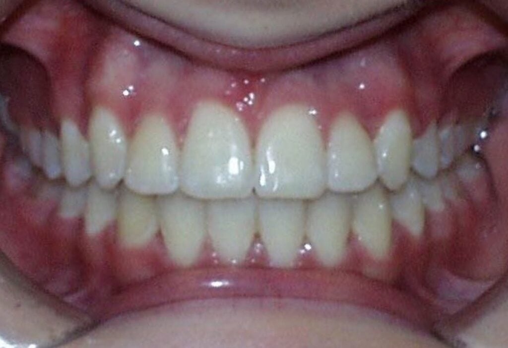 Frontal Intraoral